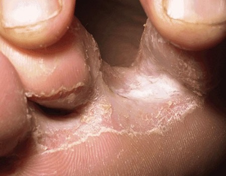 Huidschimmel voet, soorten aandoeningen