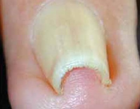 Ingroeiende en ingegroeide nagel, soorten aandoeningen